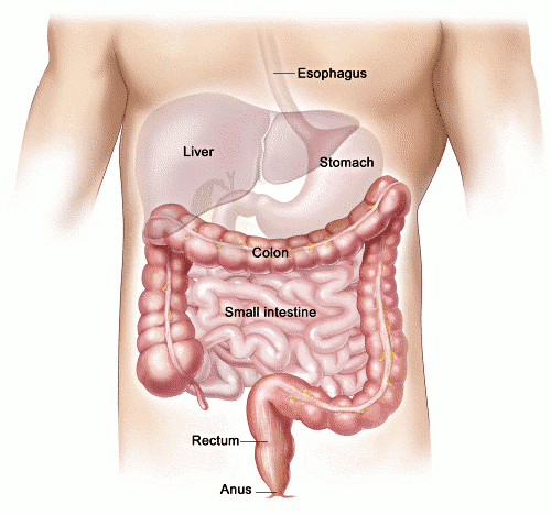 Διατροφή σε νόσο Crohn με συρίγγια